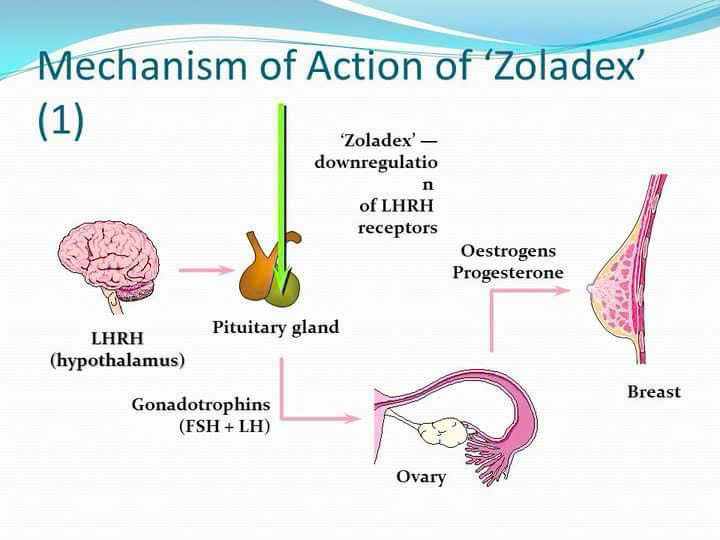 Zoladex trong điều trị lạc nội mạc tử cung giảm đau, ngừa tái phát
