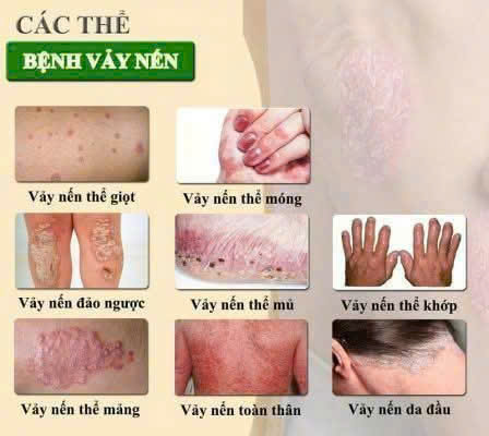 Deucravacitinib – Ưu thế của thuốc ức chế TYK-2 so với các lựa chọn điều trị vẩy nến hiện nay