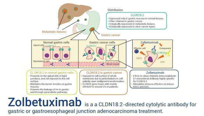  Zolbetuximab + mFOLFOX6 tăng thời gian sống không tiến triển