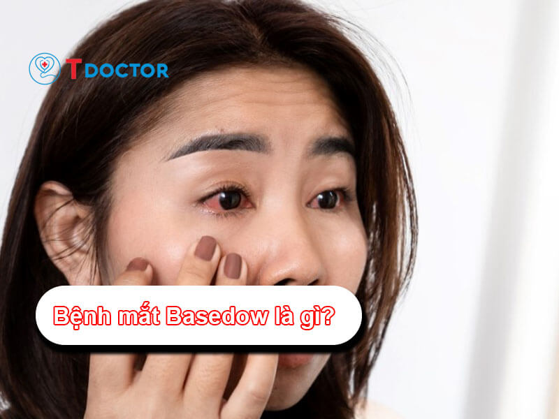 Bệnh Mắt Basedow: Nguyên nhân và cách điều trị bệnh