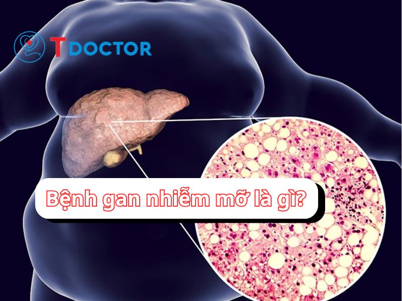 Bệnh gan nhiễm mỡ là gì? Bệnh gan nhiễm mỡ có lây không