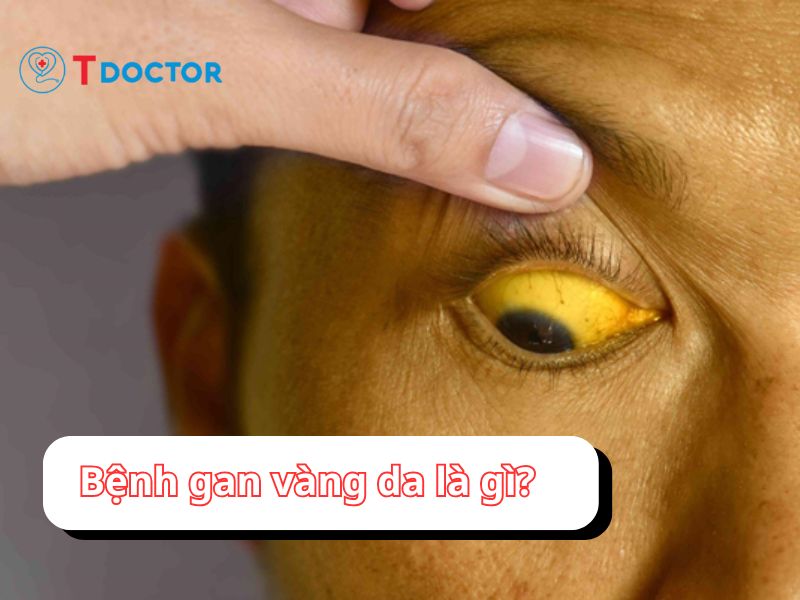 Bệnh gan vàng da: dấu hiệu cảnh báo về sức khỏe