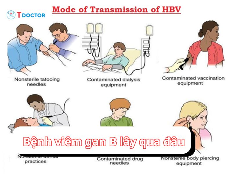 Viêm gan B lây qua đâu? Câu trả lời có tại đây