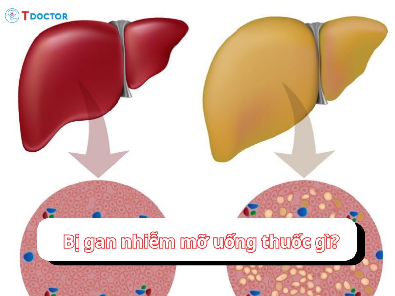 Bật mí bị gan nhiễm mỡ uống thuốc gì?