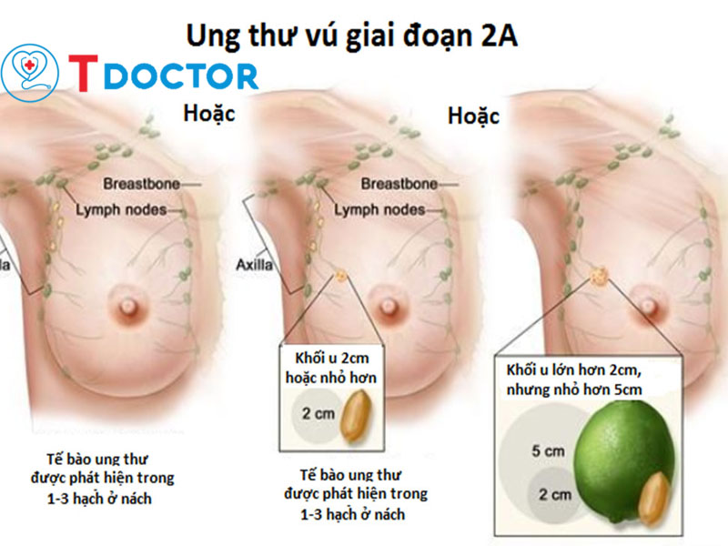 ung-thu-vu-giai-doan-2