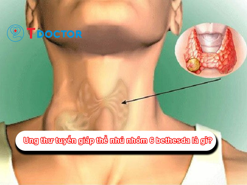 ung-thu-tuyen-giap-the-nhu-nhom-6-bethesda