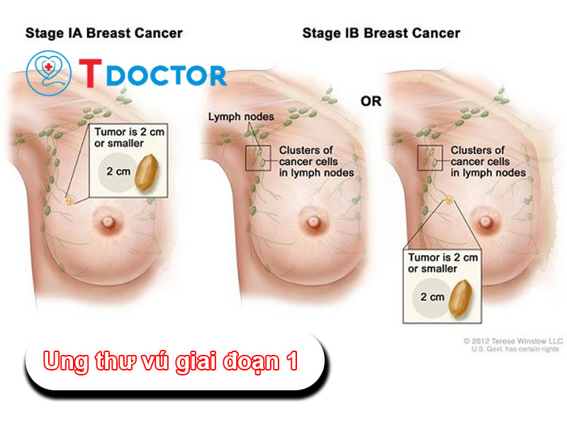 ung-thu-vu-giai-doan-1