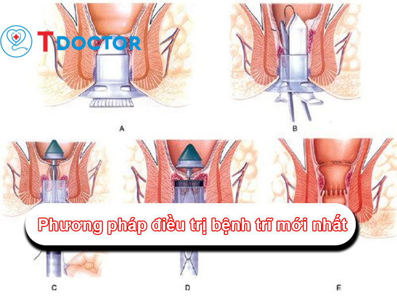 phuong-phap-dieu-tri-benh-tri-moi-nhat