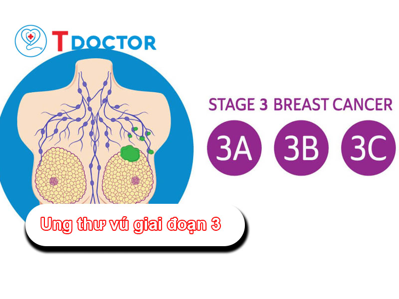 ung-thu-vu-giai-doan-3
