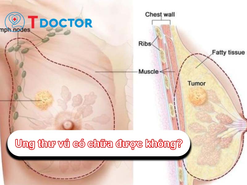 ung-thu-vu-co-chua-duoc-khong