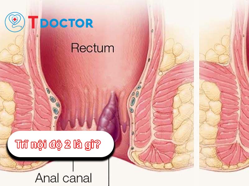 Trĩ nội độ 2: các dấu hiệu và cách điều trị