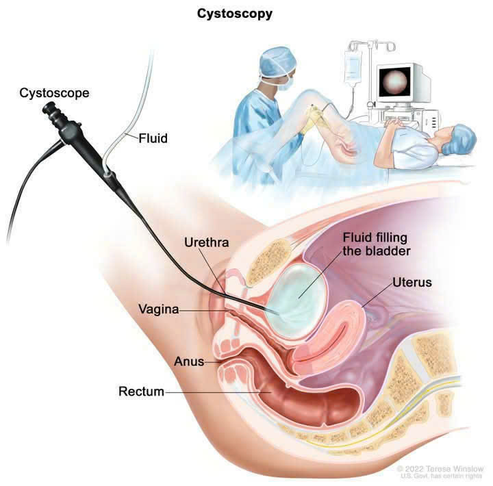 Hóa trị tại chỗ trong điều trị ung thư bàng quang giai đoạn sớm: An toàn và hiệu quả