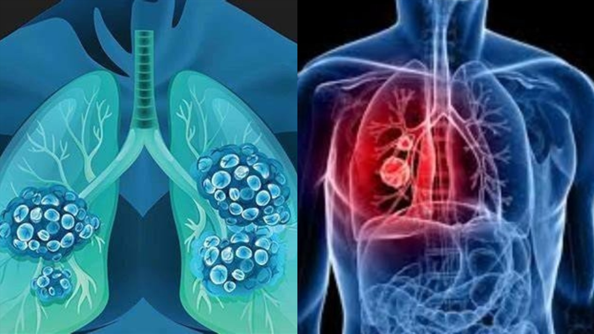 Nguyên nhân khiến nam giới Việt Nam dễ mắc ung thư phổi