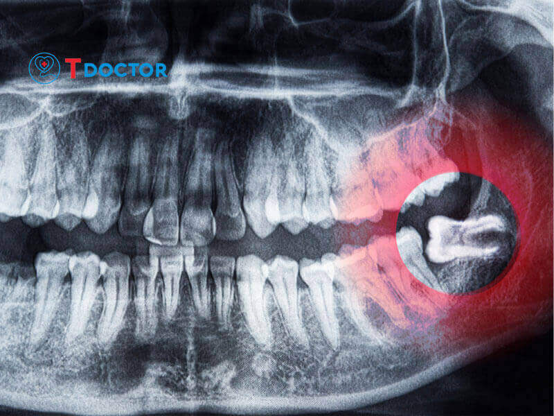 Nhổ Răng Số 8 Giá Bao Nhiêu? Giá nhổ răng tại HN và tp.HCM