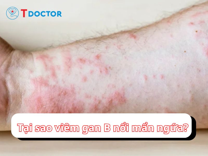 Giải đáp vì sao viêm gan B nổi mẩn ngứa?