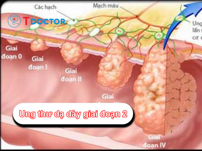 Ung thư dạ dày giai đoạn 2 và những điều người bệnh cần biết