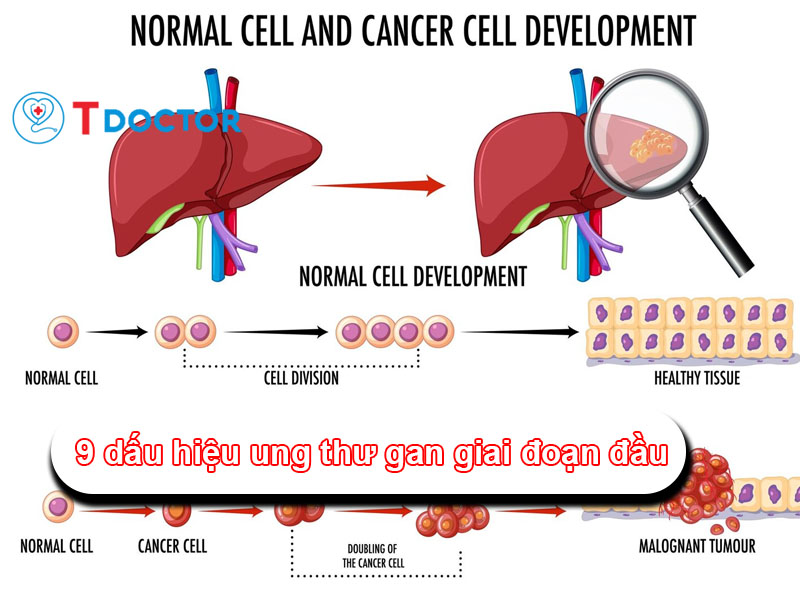 9 dấu hiệu ung thư gan giai đoạn đầu mọi người cần biết 