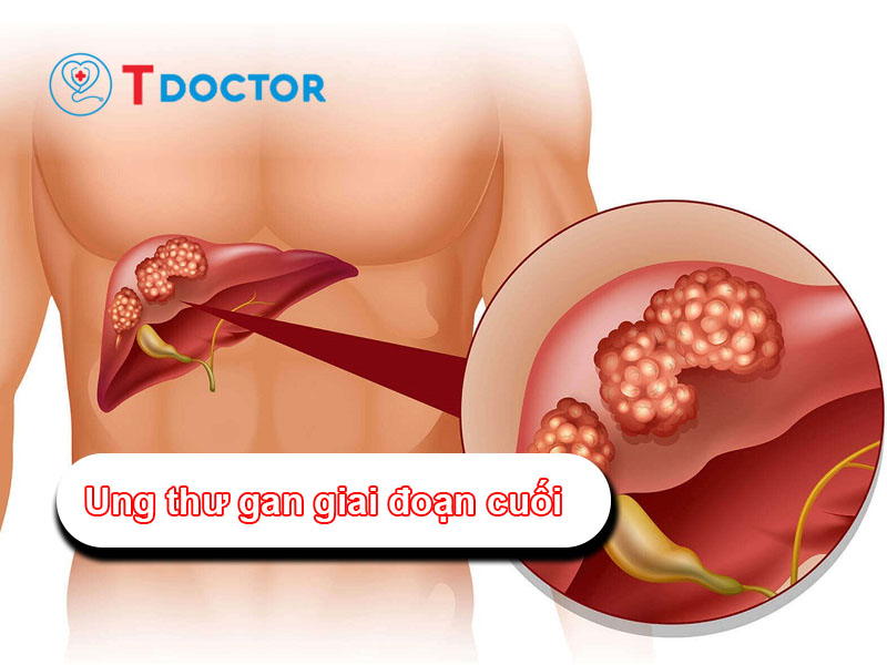 Ung thư gan giai đoạn cuối: 9 dấu hiệu mà bạn phải biết