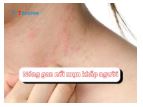 Nóng gan nổi mụn khắp người và cách khắc phục hiệu quả