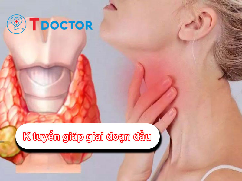 K tuyến giáp giai đoạn đầu và những thông tin bạn cần phải biết