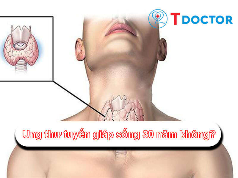 Giải đáp câu hỏi "ung thư tuyến giáp sống 30 năm không"