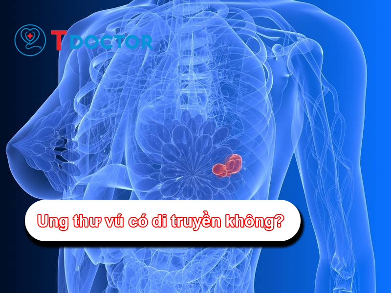 Ung thư vú có di truyền không? và tính di truyền trong K vú