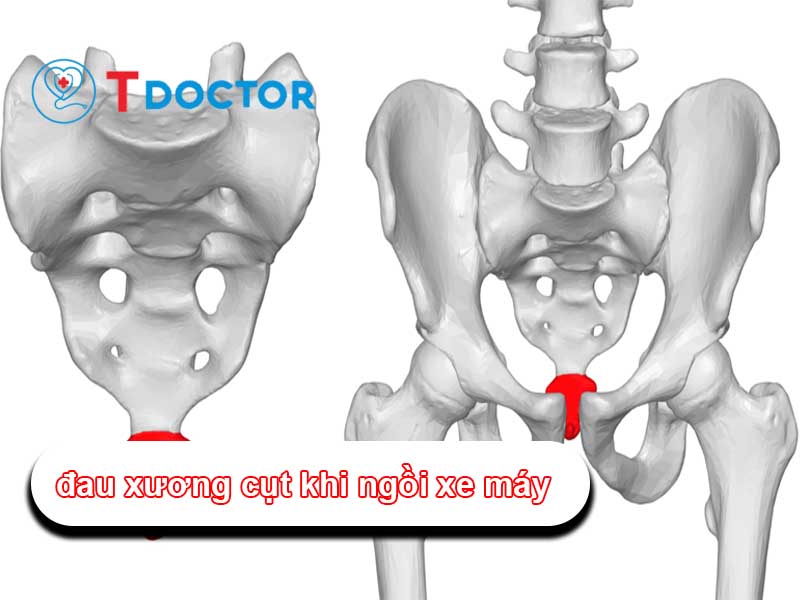 Nguyên nhân và cách giảm đau xương cụt khi ngồi xe máy