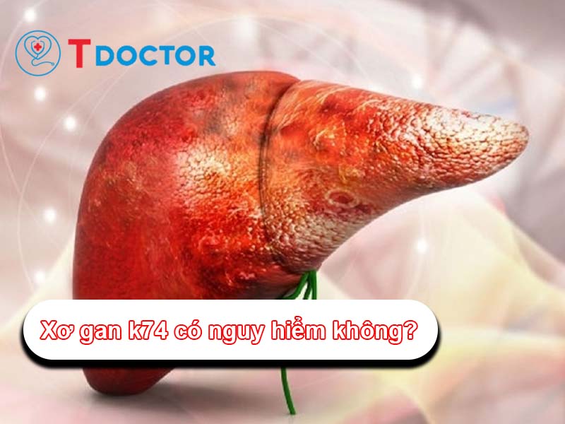 Xơ gan k74 có nguy hiểm không? Các triệu chứng nhận biết