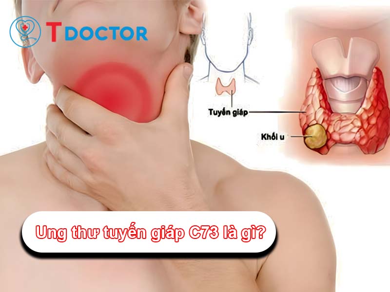 Ung thư tuyến giáp C73 là gì? Những điều cần biết về ICD C73