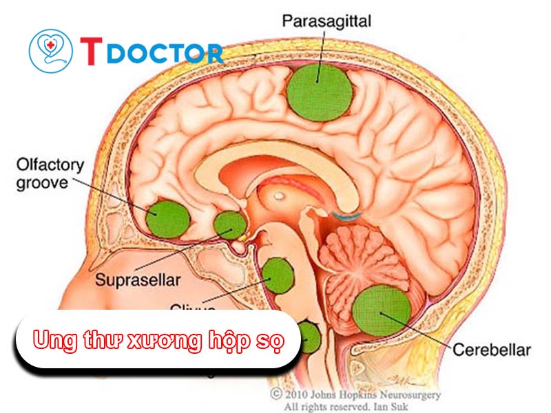 Ung thư xương hộp sọ:Nguyên nhân, triệu chứng của bệnh này