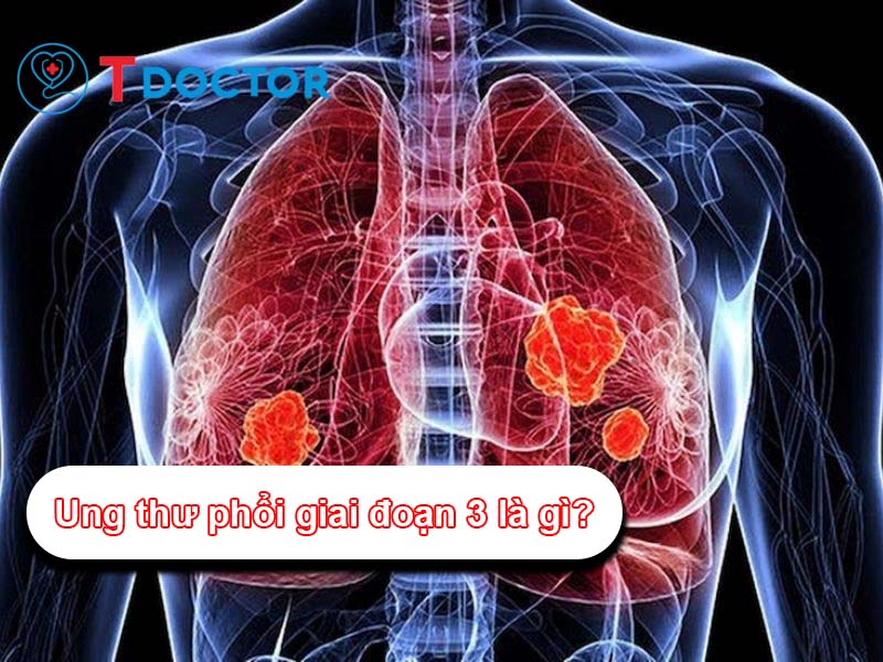 Ung thư phổi giai đoạn 3 là gì? Thời gian sống bao lâu?