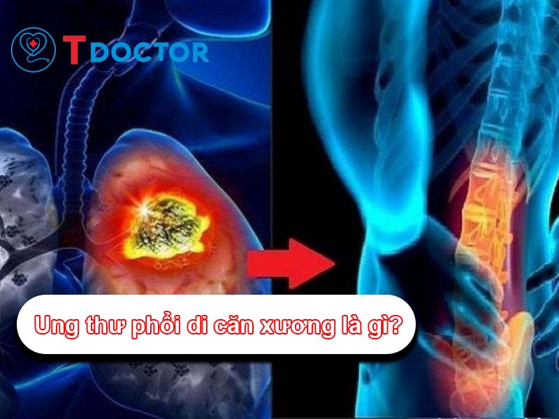 Ung thư phổi di căn xương là gì? Dấu hiệu và cách điều trị