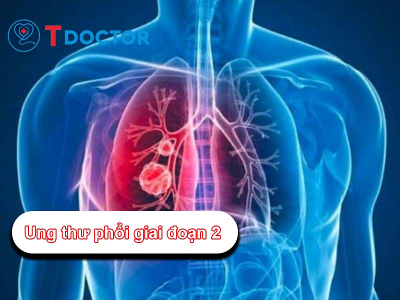 Ung thư phổi giai đoạn 2: Thông tin triệu chứng và cách điều trị