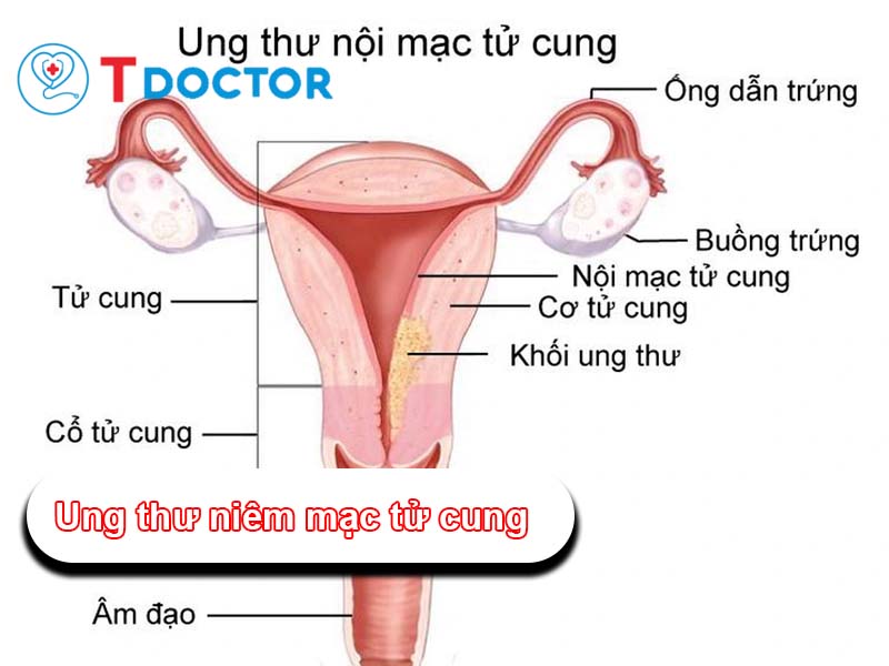 Ung Thư Niêm Mạc Tử Cung: Triệu Chứng, Nguyên Nhân là gì?